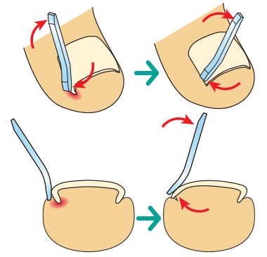 巻き爪矯正の図解